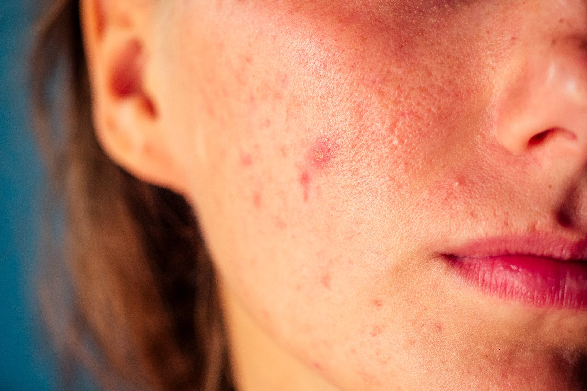 Dermatologo Ambato Acne Mujer Adulta-min