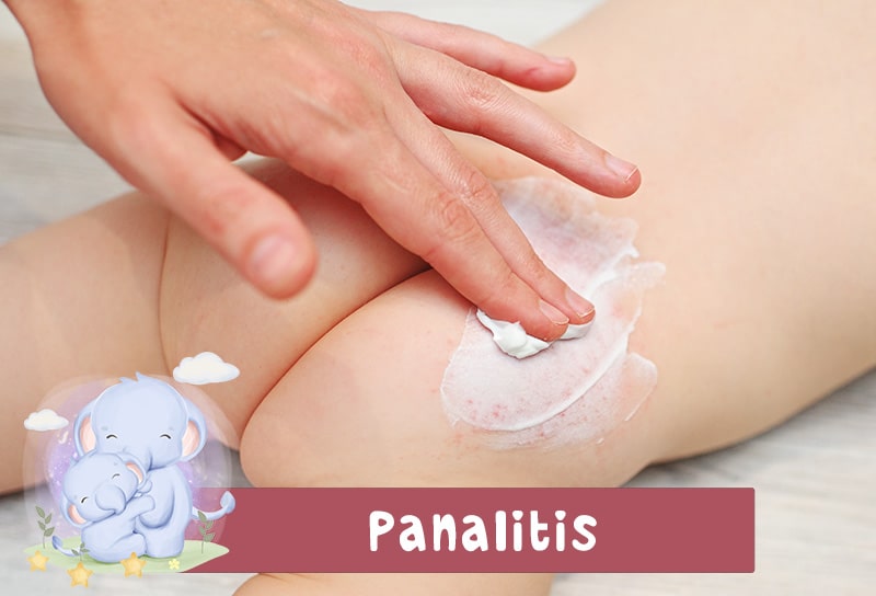 Dermatologo Pediatra Ambato Tratamiento Pañalitis-min