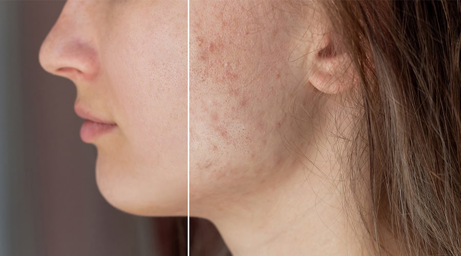 Dermatólogo Ambato Tratamiento Acné-min