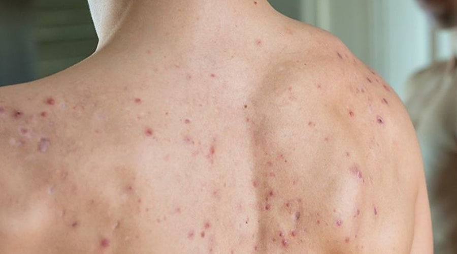 Dermatólogo Ambato Tratamiento Espinillas Barros Espalda-min