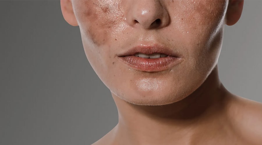 Manchas en la piel Ambato Melasma Tratamiento2-min Manchas en la piel Ambato Melasma Tratamiento2-min