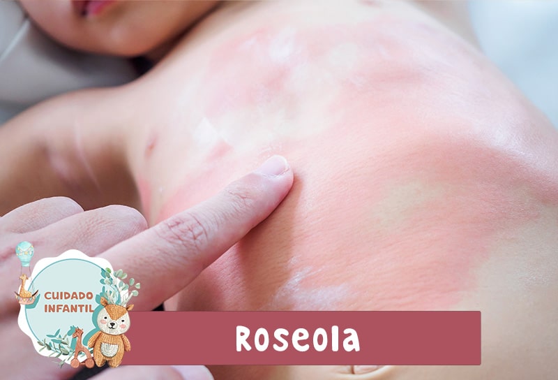 Roseola Bebe Tratamiento Dermatólogo Pediatra Ambato-min