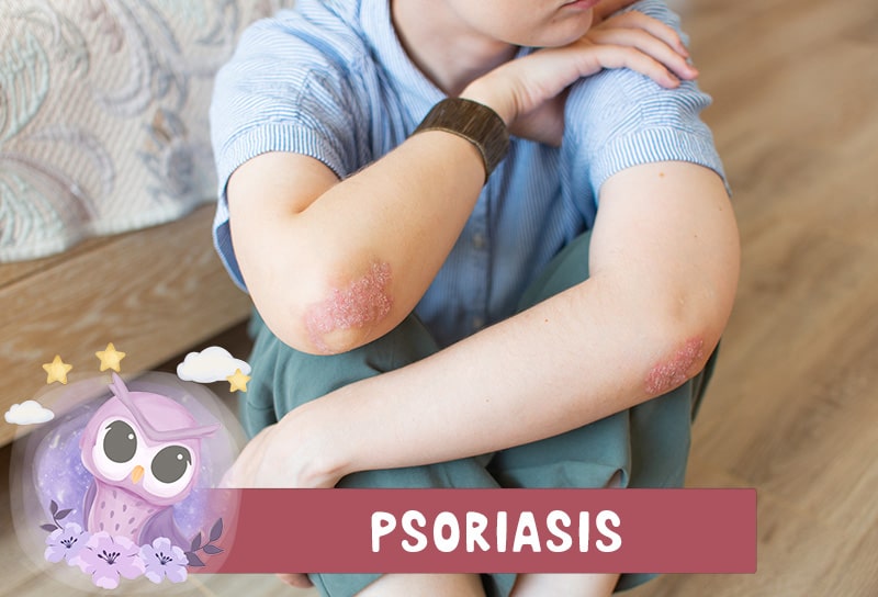 Tratamiento Psoriasis Infantiil Dermatólogo Pediatra Ambato-min