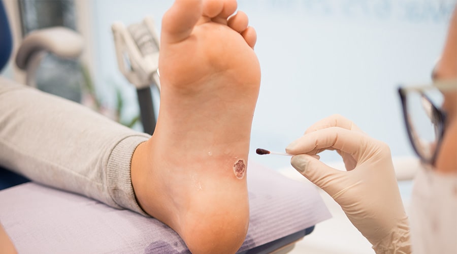 Verrugas Ambato Dermatólogo Ambato-min