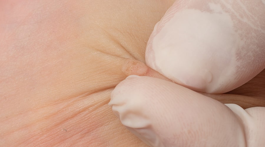 Tratamiento Verrugas Ambato Dermatólogo Ambato2-min