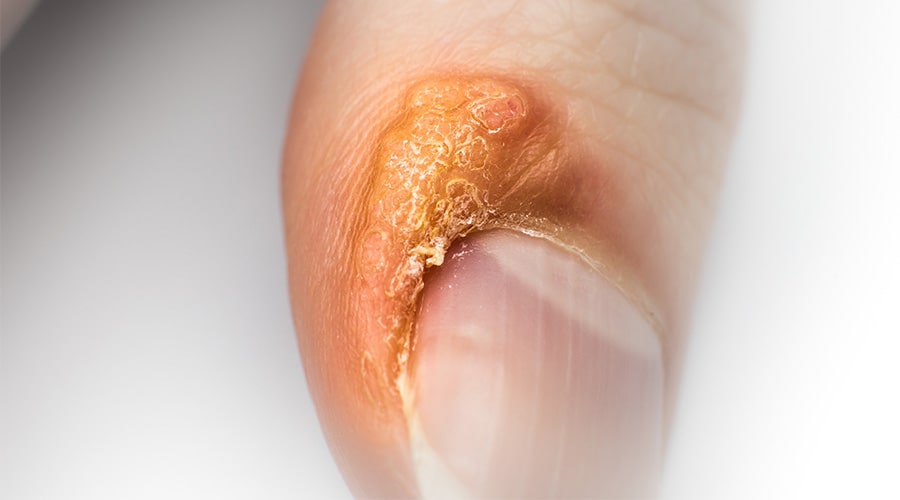 Tratamiento Verrugas Ambato Dermatólogo Ambato3-min