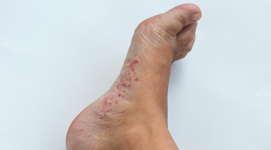 Tratamiento hongos en las manos pies uñas ambato dermatólogo ambato-min