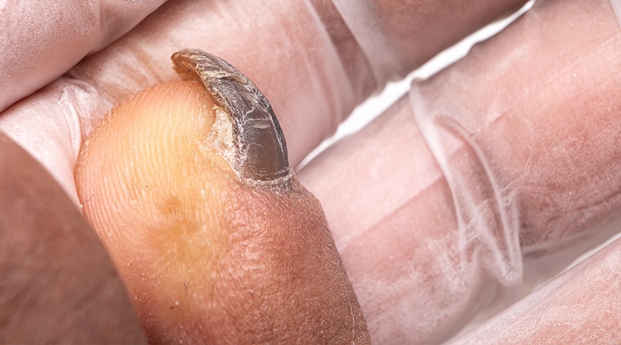 Tratamiento hongos en las manos pies uñas ambato dermatólogo ambato1-min