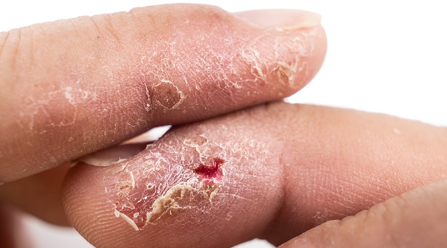 Tratamiento hongos en las manos pies uñas ambato dermatólogo ambato2-min